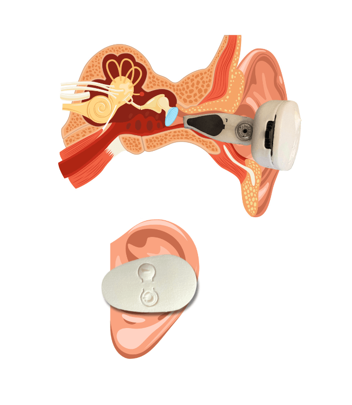 Cross-section view illustrating the EVANES unique electrode placement for effective Vagus Nerve activation in the ear.