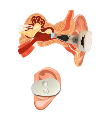 Cross-section view illustrating the EVANES unique electrode placement for effective Vagus Nerve activation in the ear.